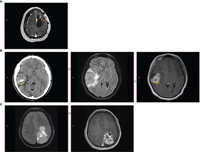 Heterogeneous clinicopathological findings and patient-reported outcomes in adults with MN1-altered CNS tumors: A case report and systematic literature review